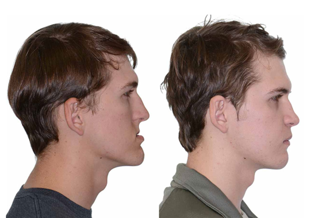 3 key points about jaw and face angulation
